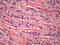 Breast lesion 