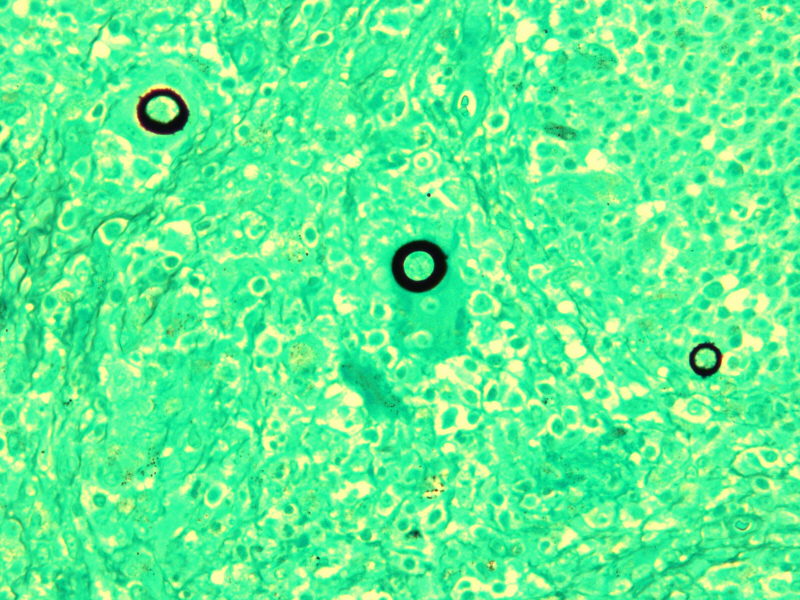 Coccidioides Immitis GMS